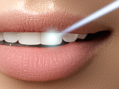 Sound Shore Vision Center | Full Mouth Rejuvenation, E4D and Dental Bridges